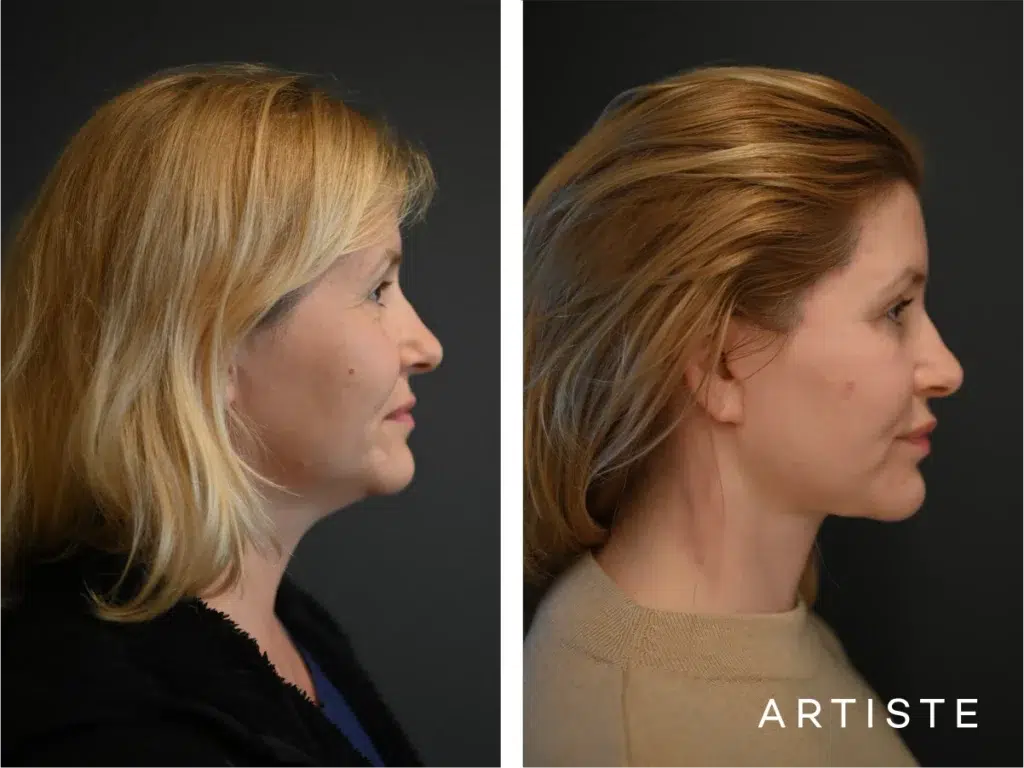 47 Years Old: Deep Plane Face And Neck Lift
