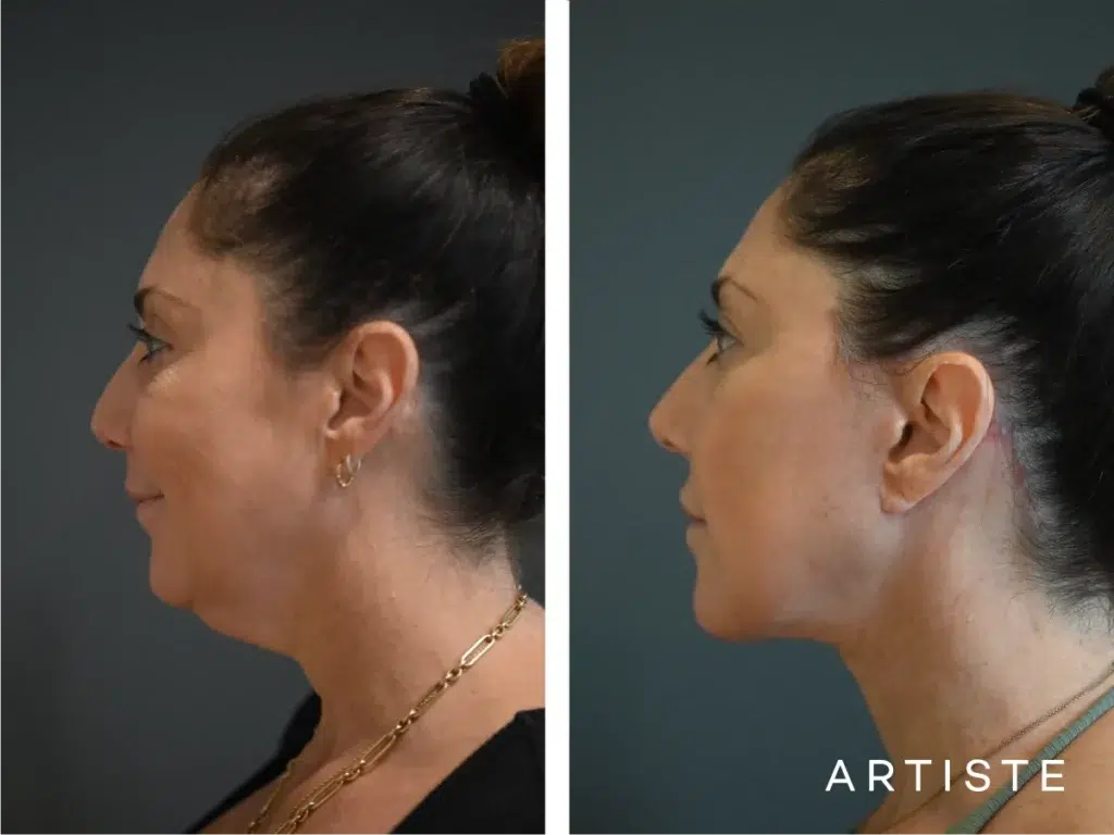 49 Years Old: Deep Plane Face And Neck Lift