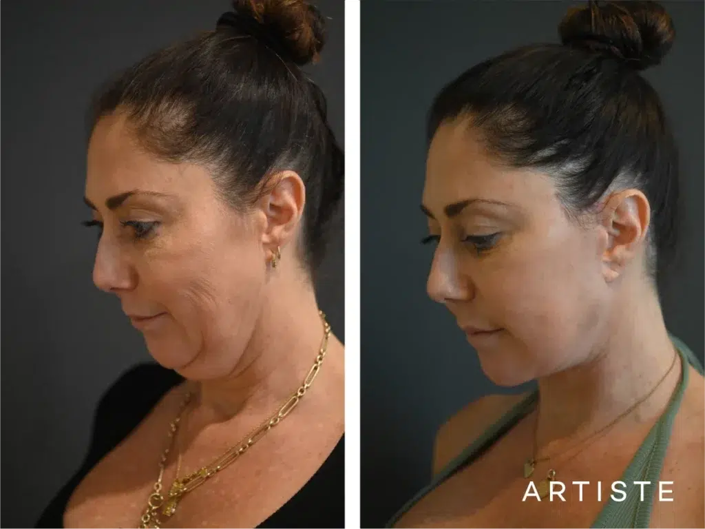 49 Years Old: Deep Plane Face And Neck Lift