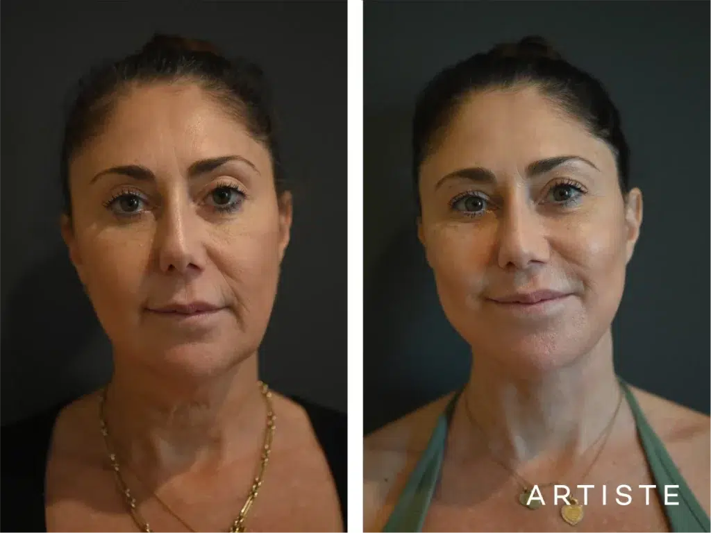 49 Years Old: Deep Plane Face And Neck Lift