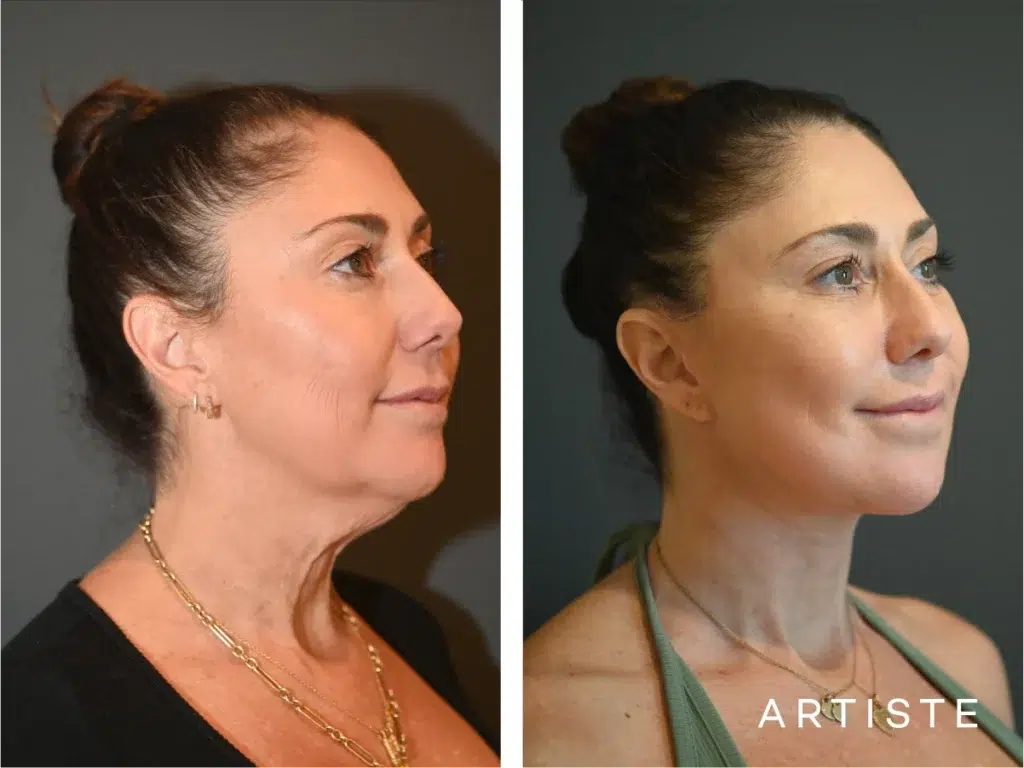 49 Years Old: Deep Plane Face And Neck Lift
