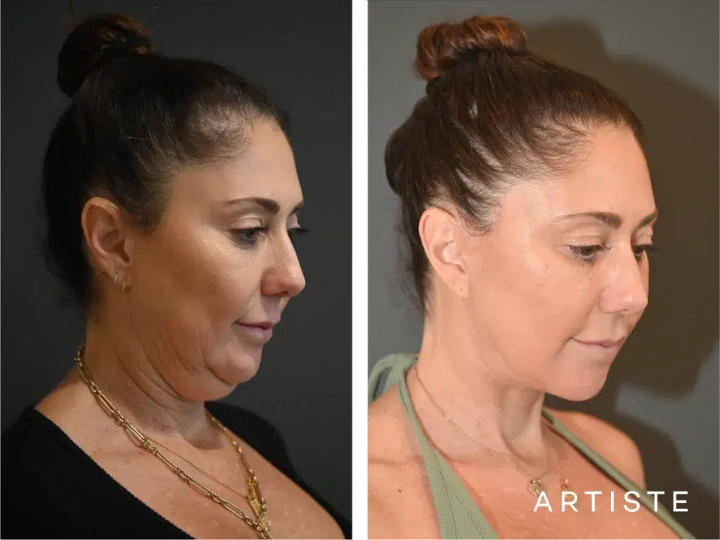 49 Years Old: Deep Plane Face And Neck Lift