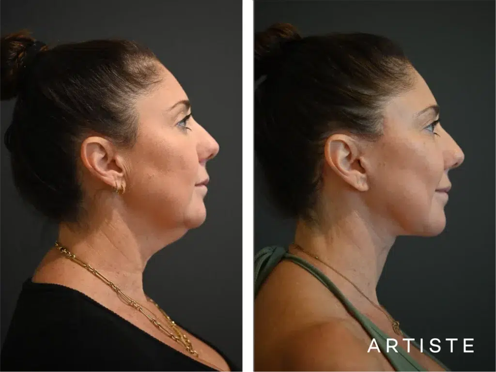 49 Years Old: Deep Plane Face And Neck Lift