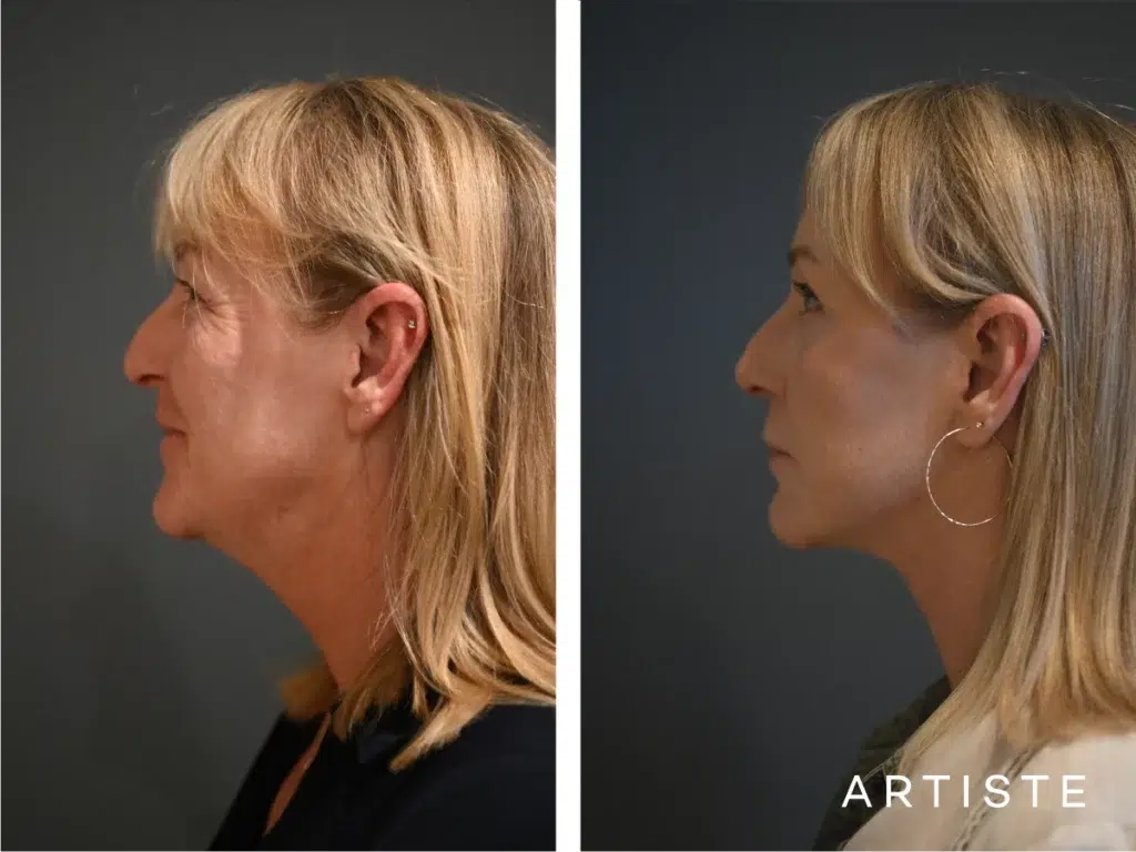 52 Years Old: High Smas Face And Neck