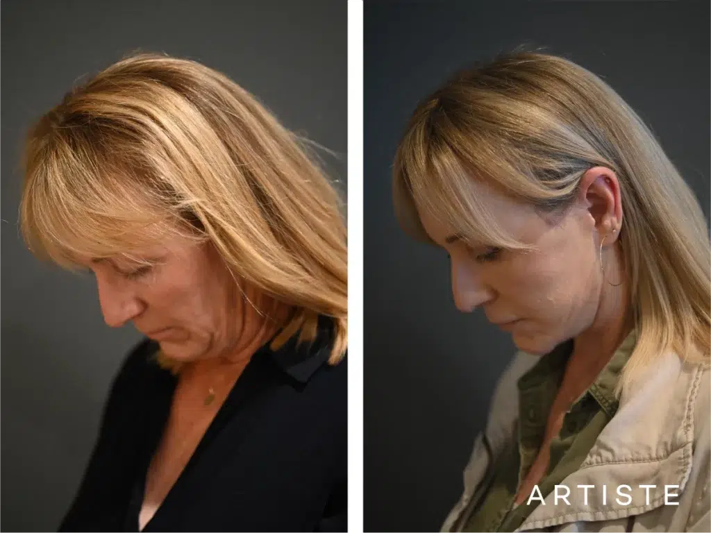 52 Years Old: High Smas Face And Neck