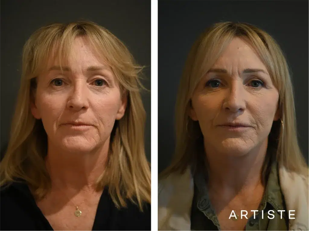52 Years Old: High Smas Face And Neck