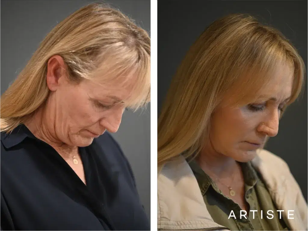 52 Years Old: High Smas Face And Neck