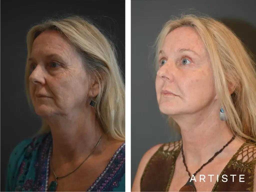 57 Years Old: Deep Plane Face Lift And Eyelids