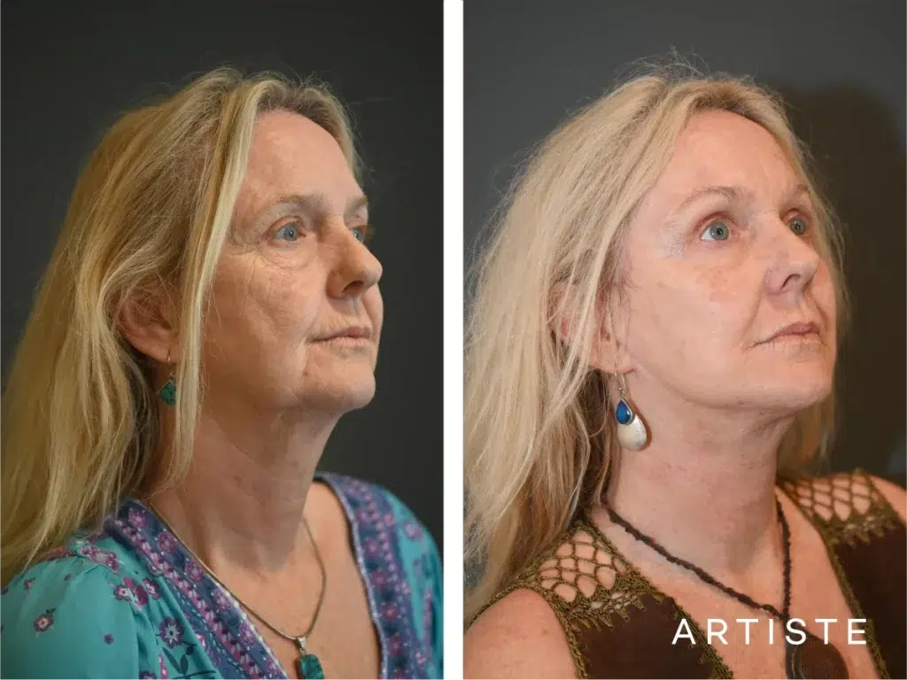 57 Years Old: Deep Plane Face Lift And Eyelids