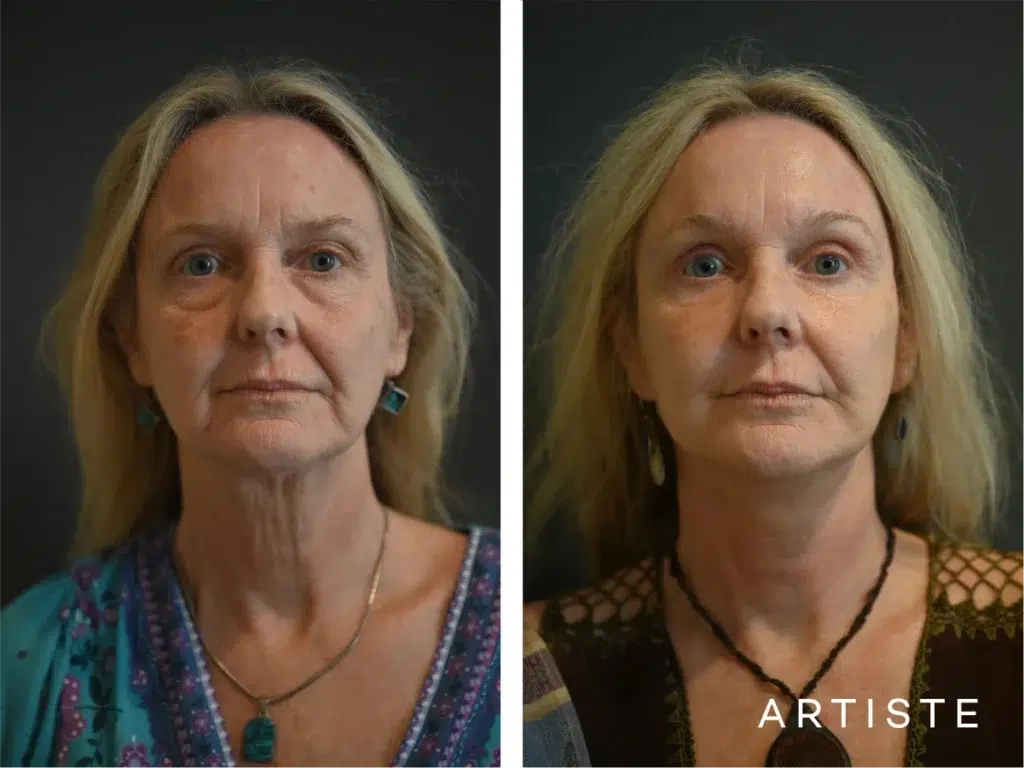57 Years Old: Deep Plane Face Lift And Eyelids