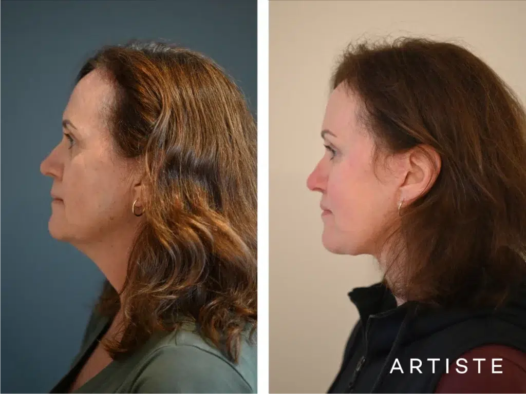 57 Years Old: Deep Plane Face, Neck ,eyes
