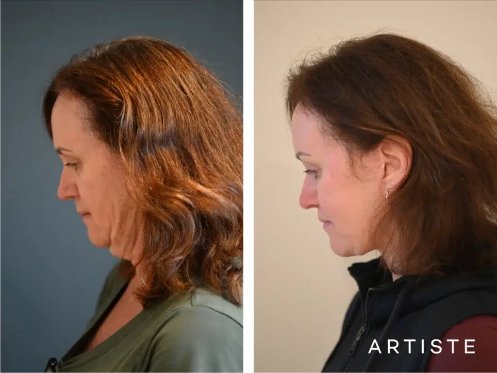 57 Years Old: Deep Plane Face, Neck ,eyes