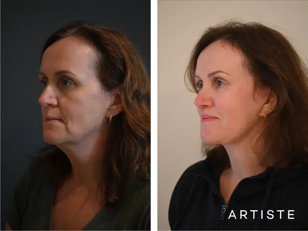 57 Years Old: Deep Plane Face, Neck ,eyes