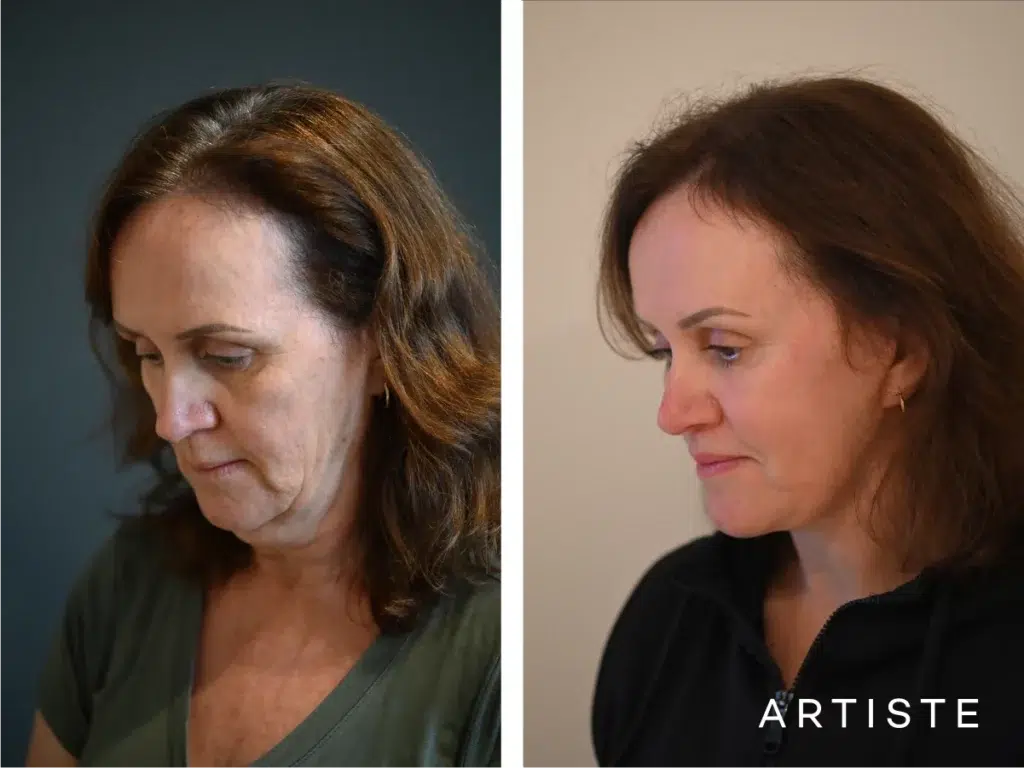 57 Years Old: Deep Plane Face, Neck ,eyes