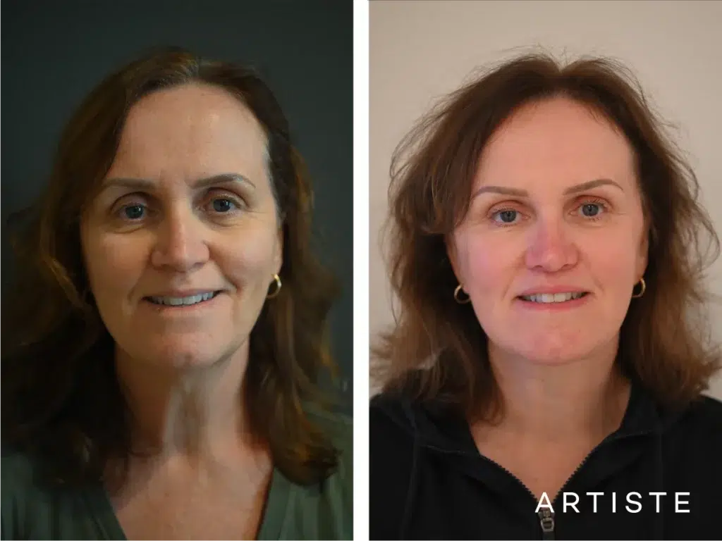 57 Years Old: Deep Plane Face, Neck ,eyes