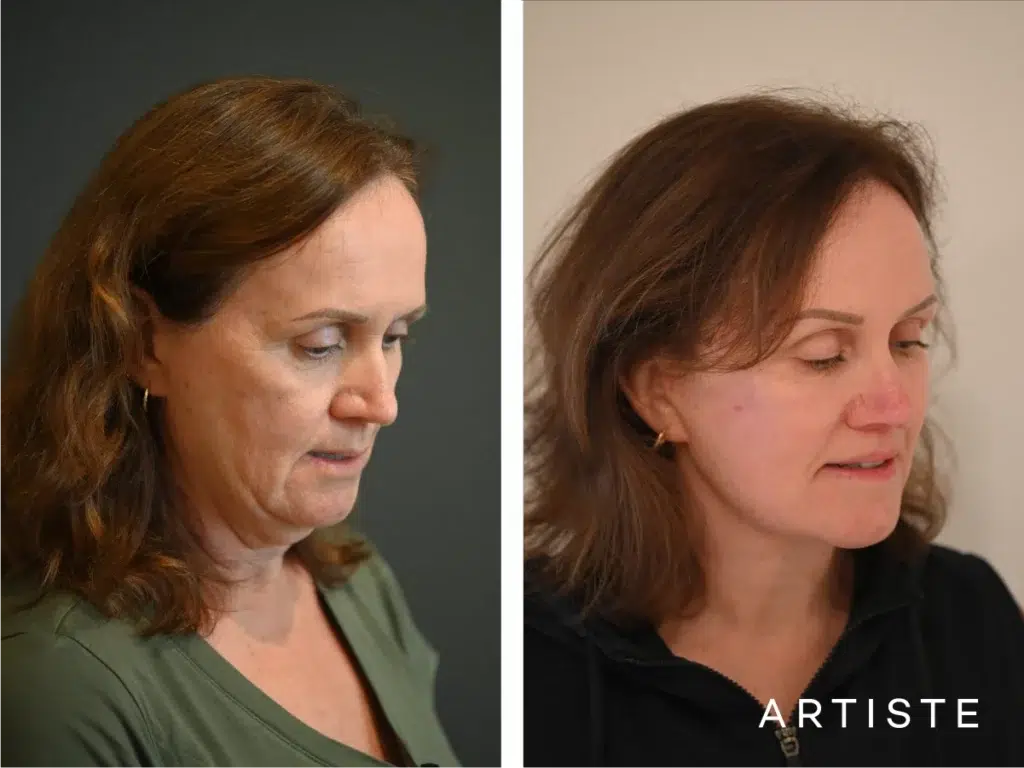 57 Years Old: Deep Plane Face, Neck ,eyes