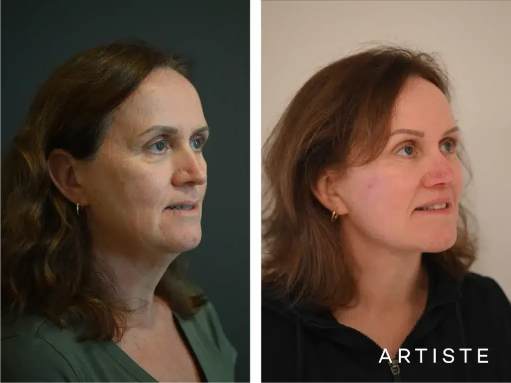 57 Years Old: Deep Plane Face, Neck ,eyes