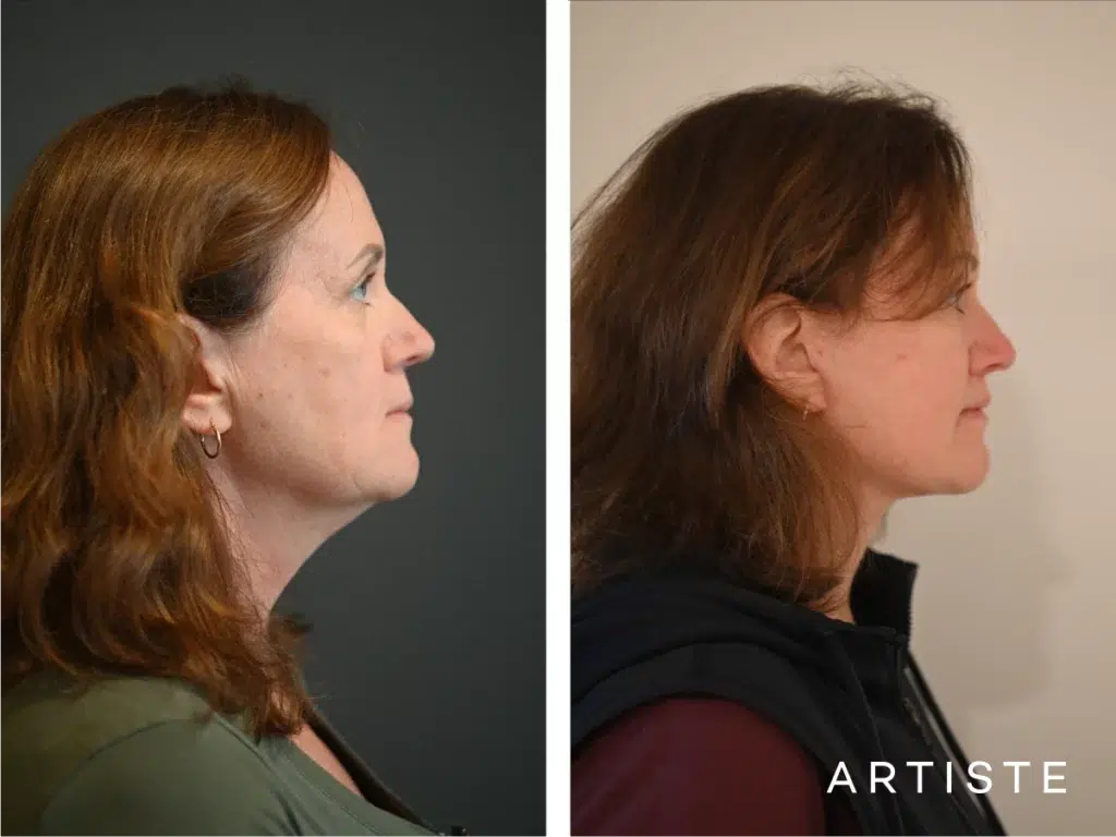 57 Years Old: Deep Plane Face, Neck ,eyes