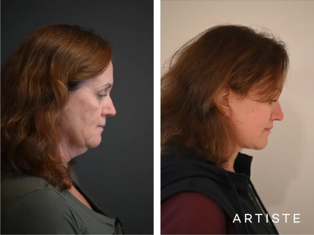 57 Years Old: Deep Plane Face, Neck ,eyes
