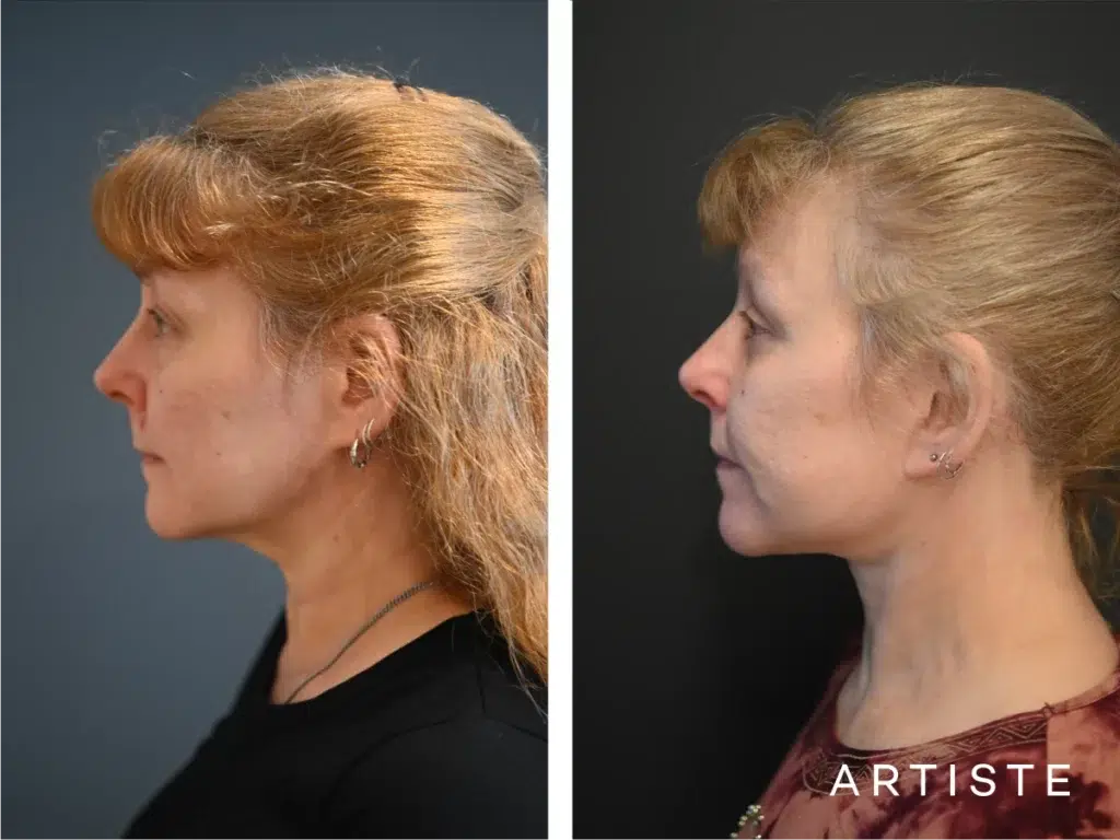 58 Years Old: High Smas Face And Neck And Eyes