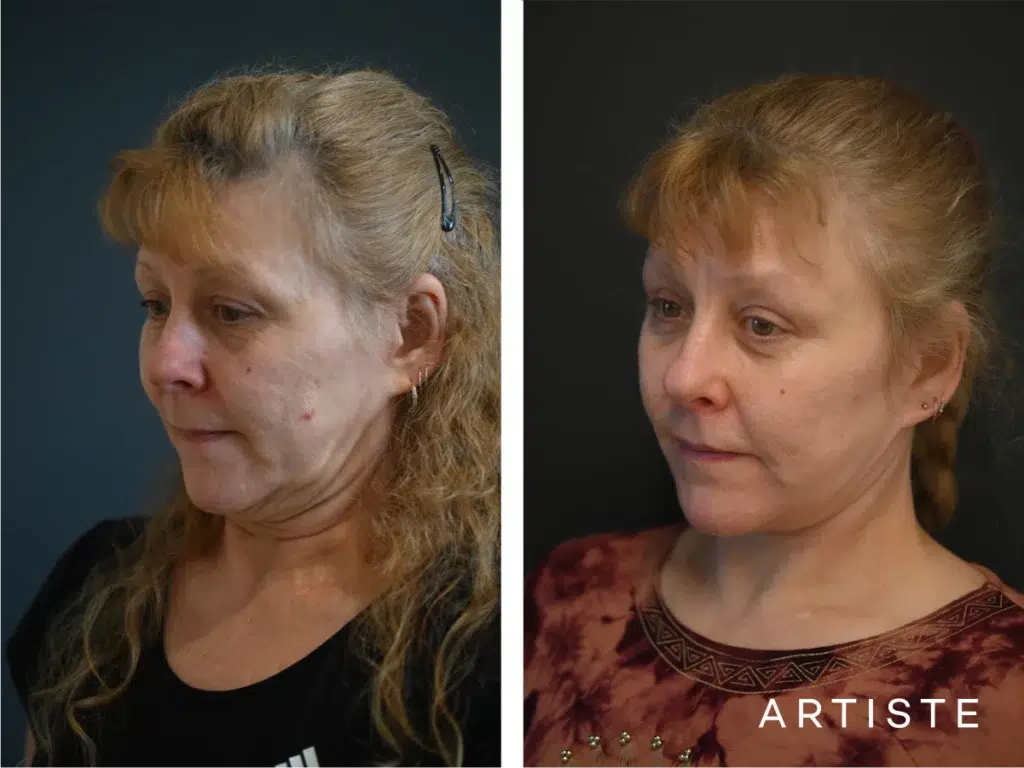 58 Years Old: High Smas Face And Neck And Eyes