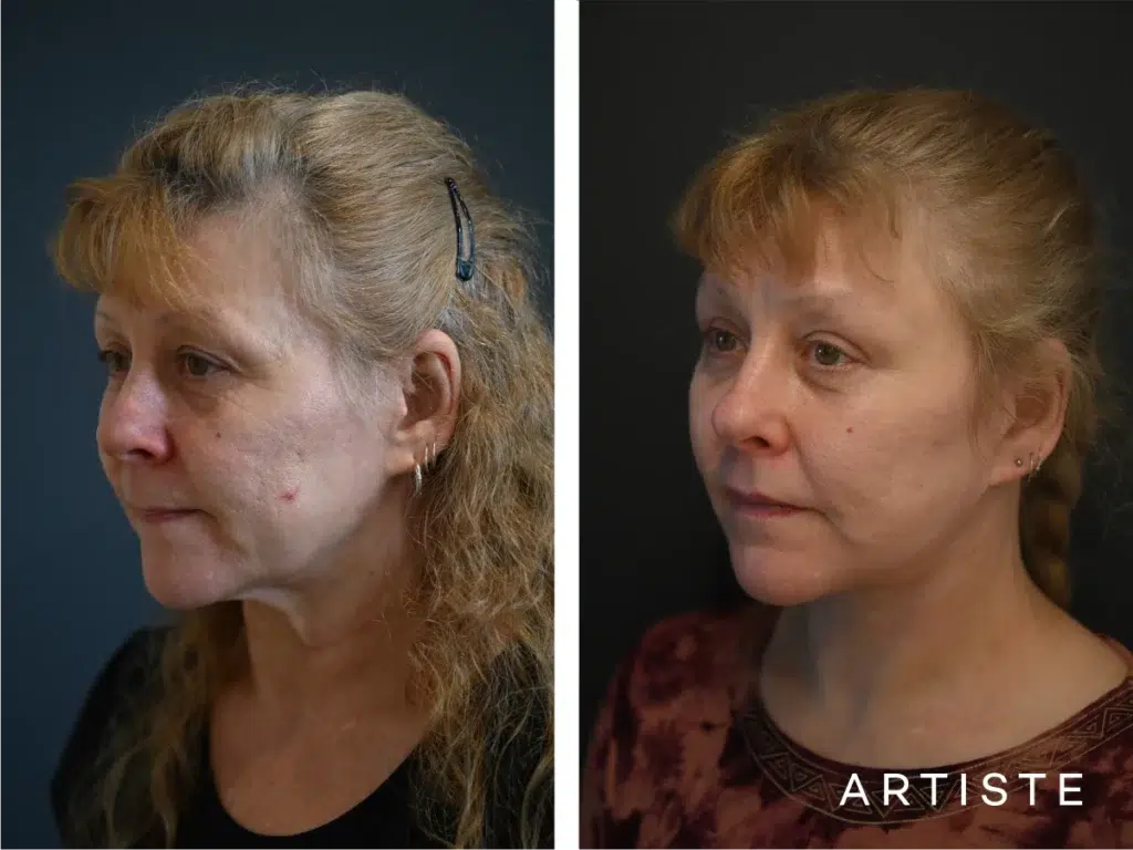 58 Years Old: High Smas Face And Neck And Eyes