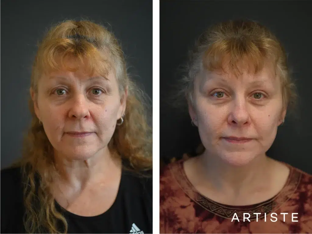 58 Years Old: High Smas Face And Neck And Eyes