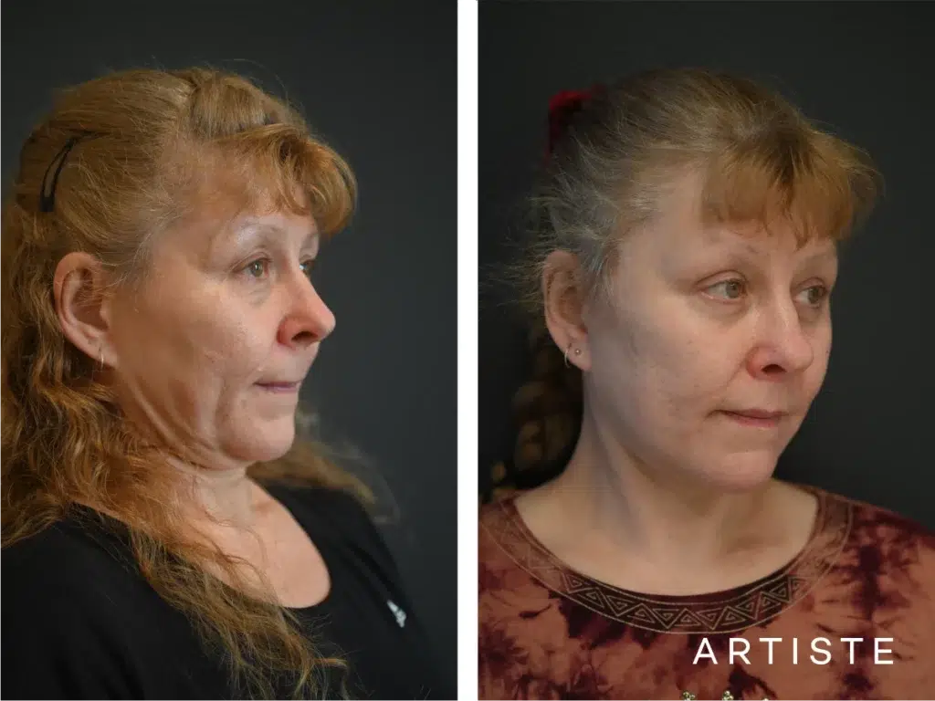 58 Years Old: High Smas Face And Neck And Eyes