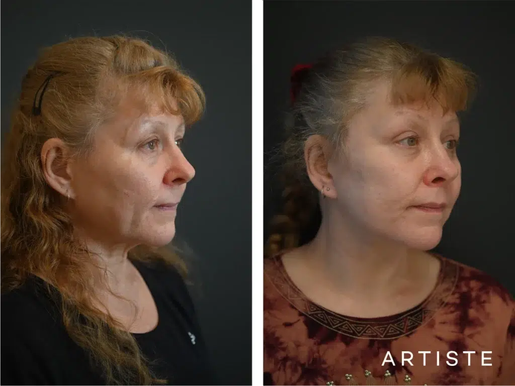 58 Years Old: High Smas Face And Neck And Eyes