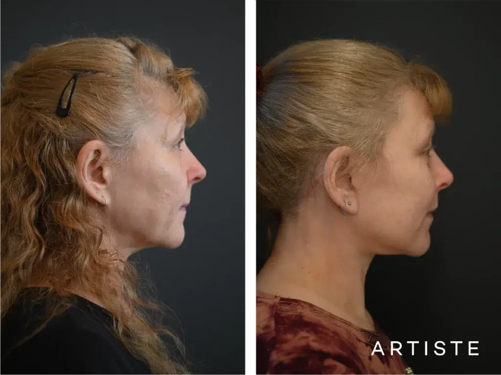 58 Years Old: High Smas Face And Neck And Eyes