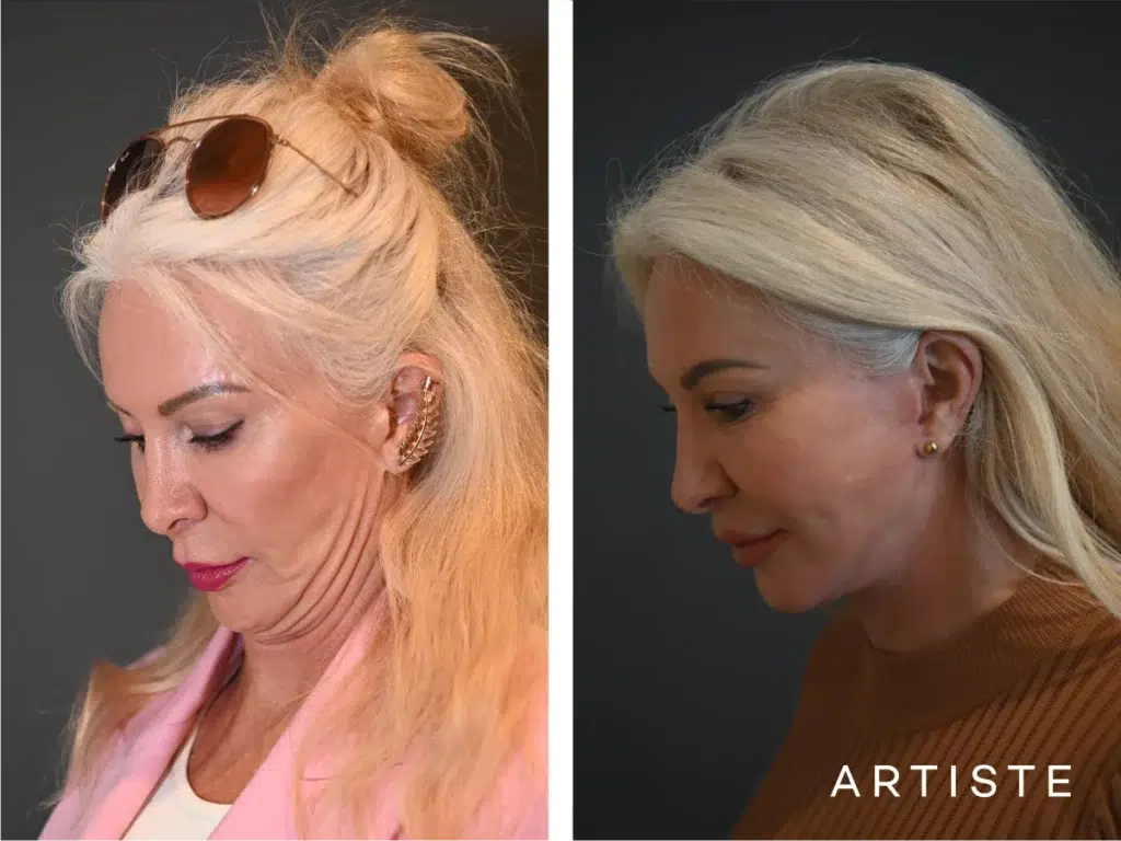 59 Years Old: Deep Plane Face and Neck Lift, Micro Fat Grafting, Peri-Oral Dermabrasion and Chemical Peel