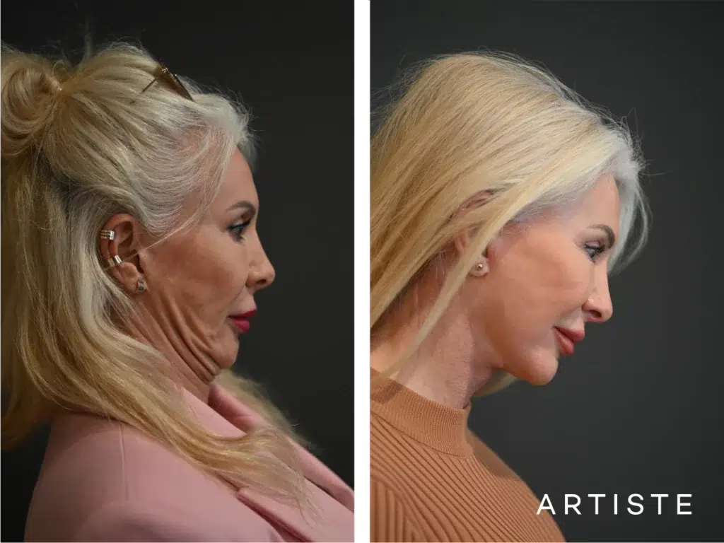 59 Years Old: Deep Plane Face and Neck Lift, Micro Fat Grafting, Peri-Oral Dermabrasion and Chemical Peel