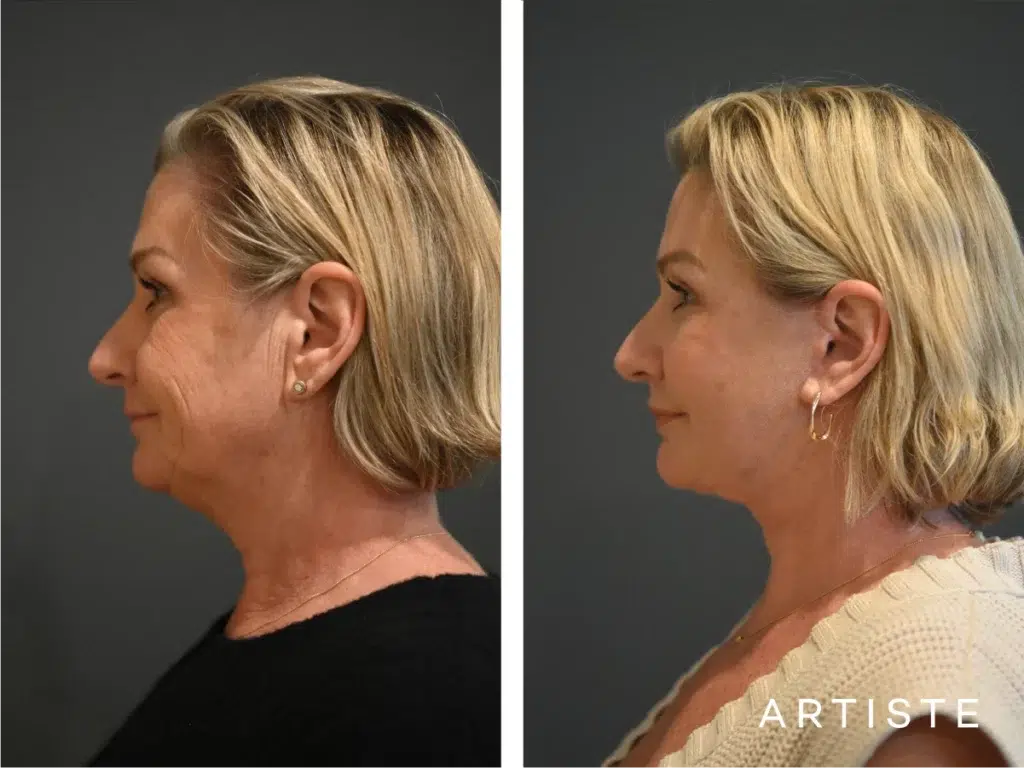 59 Years Old: High Smas Face And Neck Lift