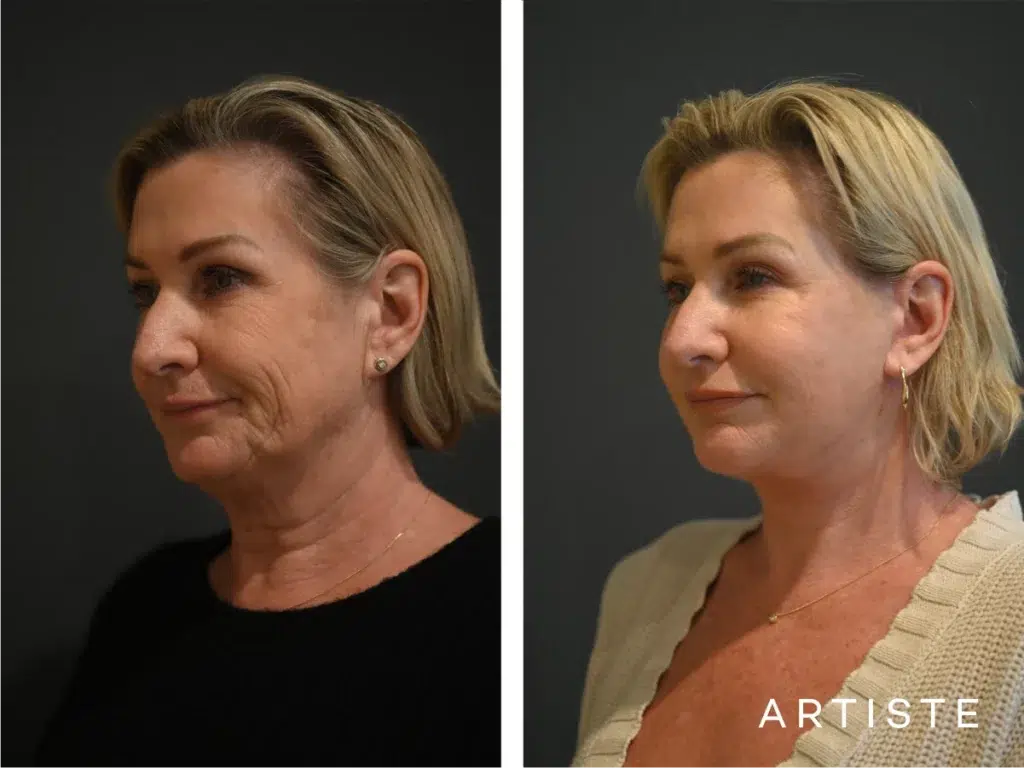 59 Years Old: High Smas Face And Neck Lift