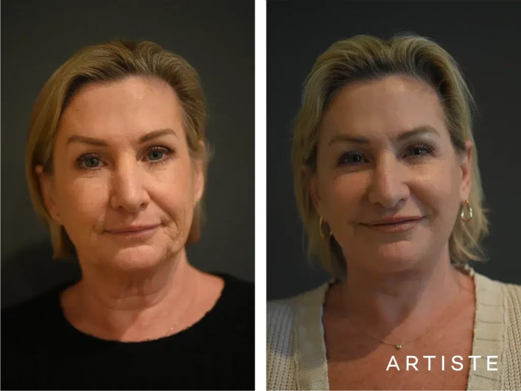 59 Years Old: High Smas Face And Neck Lift