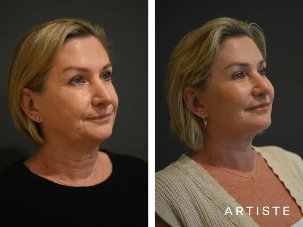59 Years Old: High Smas Face And Neck Lift