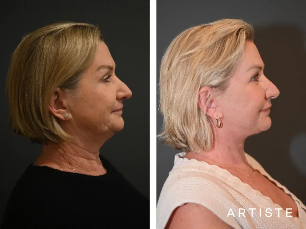 59 Years Old: High Smas Face And Neck Lift