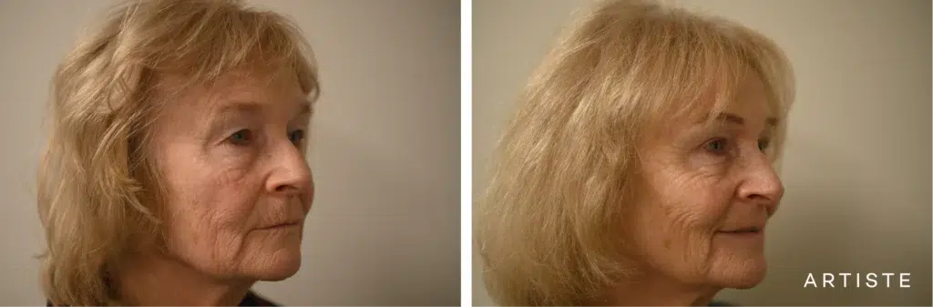 70 Years Old: Upper Eyelids