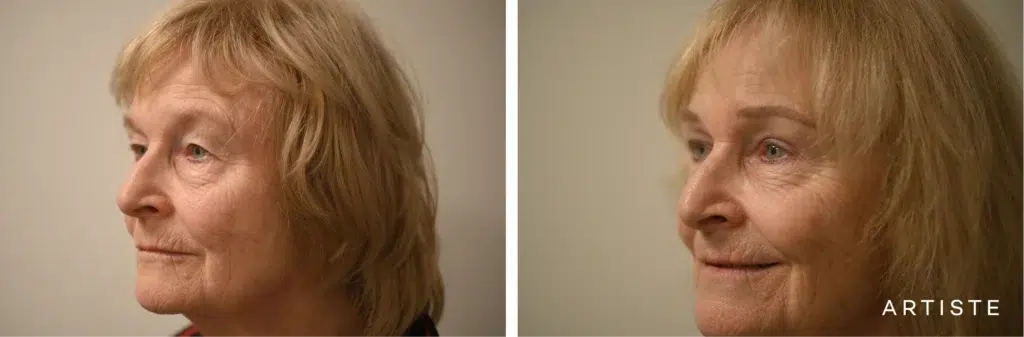 70 Years Old: Upper Eyelids