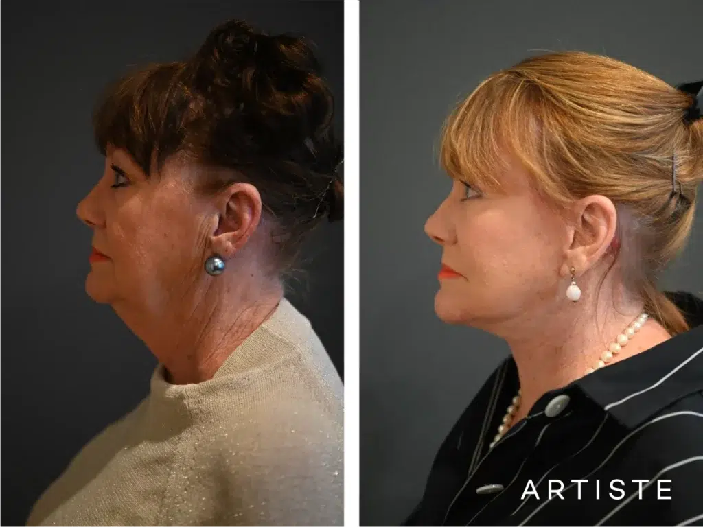 70 Years Old: Deep Neck And Facelift