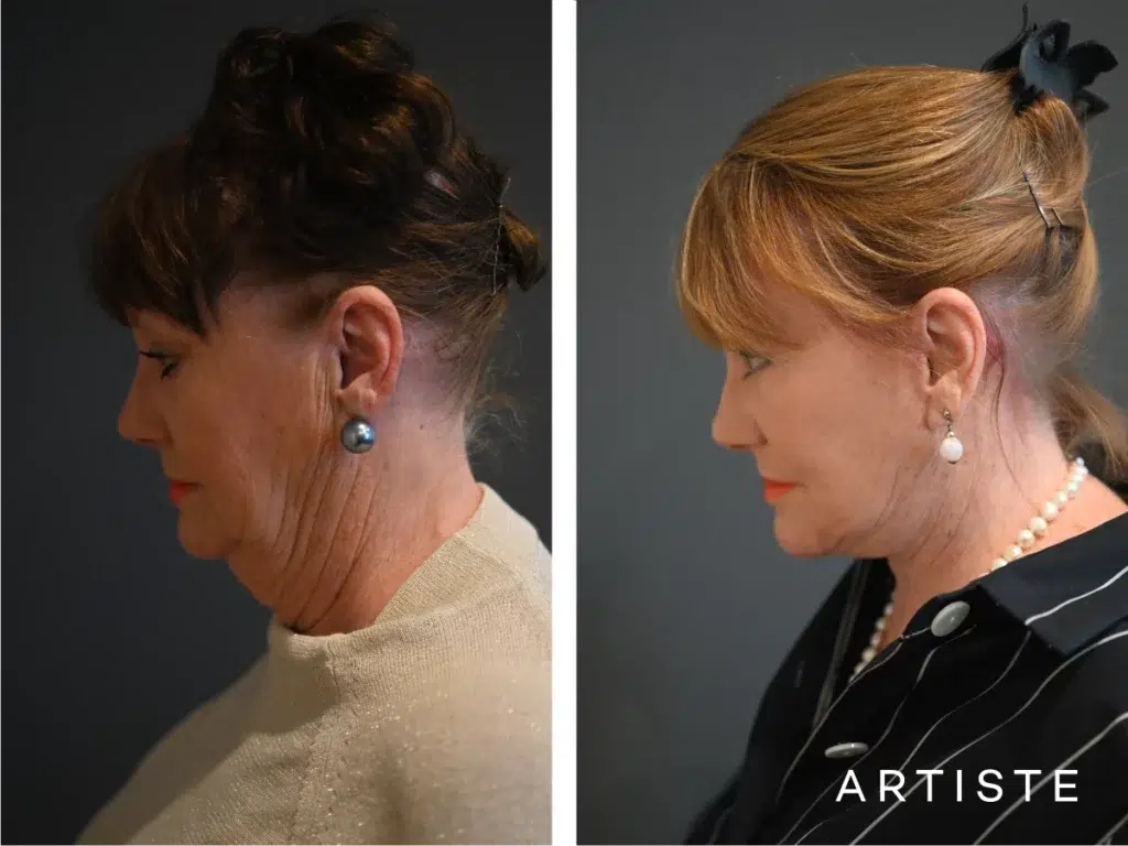70 Years Old: Deep Neck And Facelift