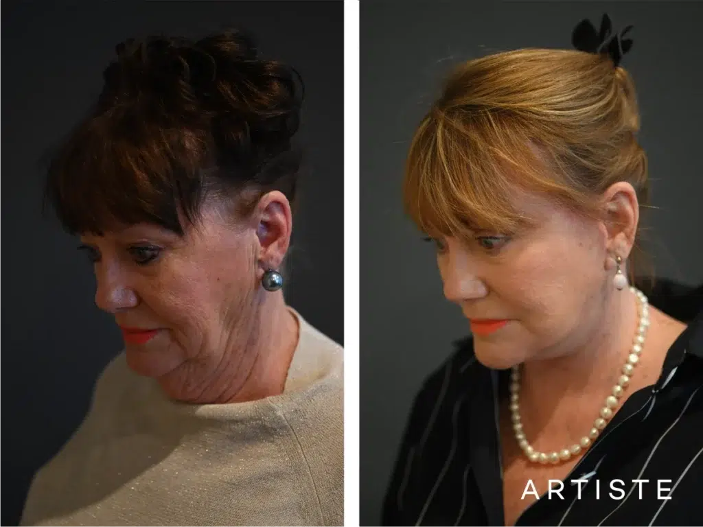 70 Years Old: Deep Neck And Facelift