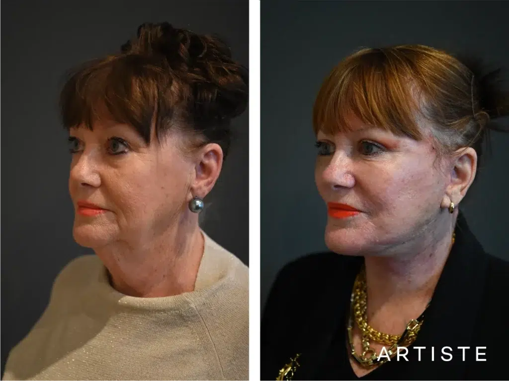 70 Years Old: Deep Neck And Facelift
