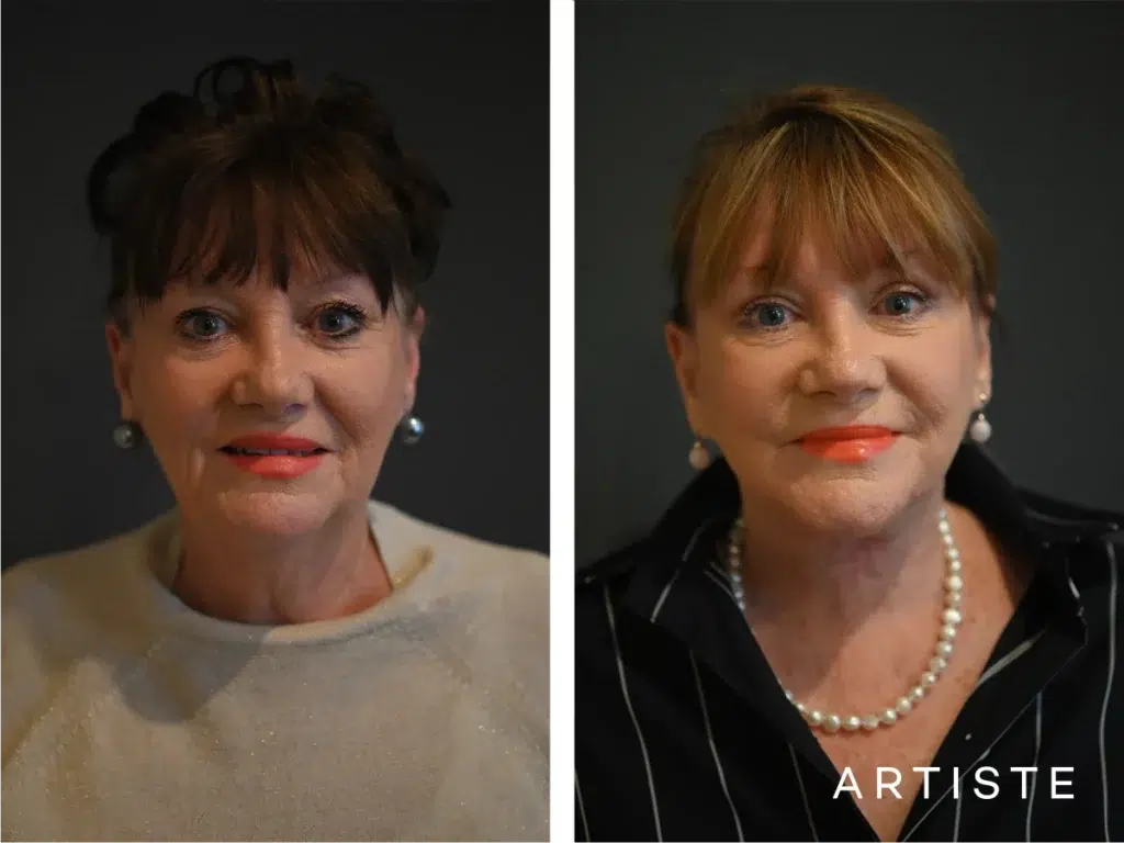 70 Years Old: Deep Neck And Facelift