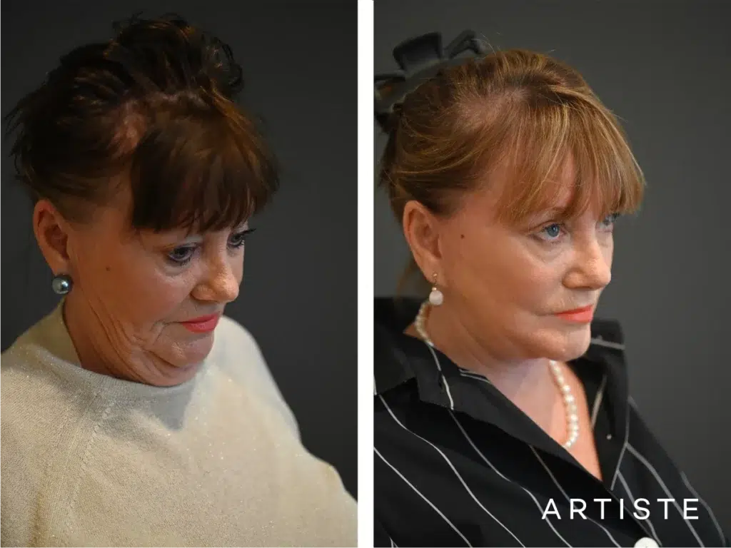 70 Years Old: Deep Neck And Facelift