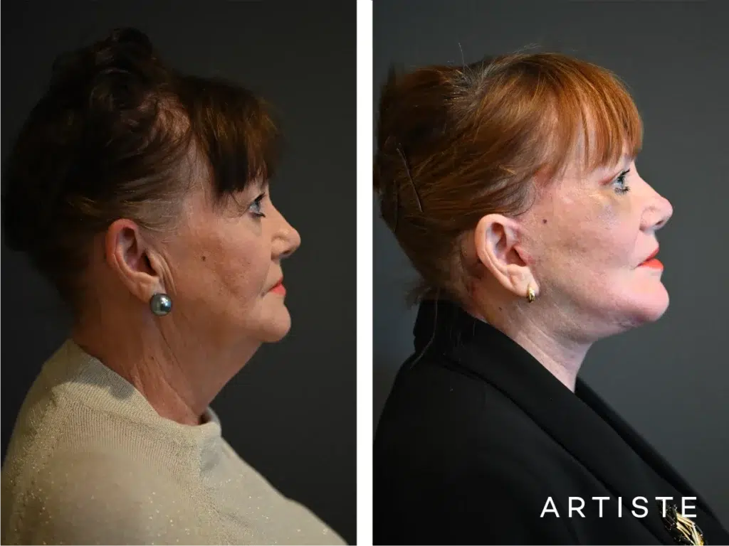 70 Years Old: Deep Neck And Facelift