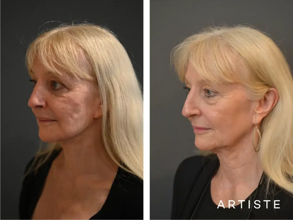 72 Years Old 12 Months Post High Smas Face And Neck Lift Lower Eyelid Surgery Fat Transfer And Lip Lift