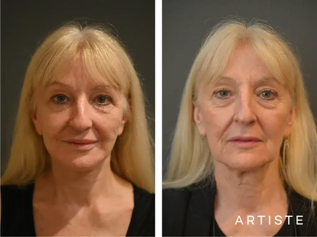 72 Years Old 12 Months Post High Smas Face And Neck Lift Lower Eyelid Surgery Fat Transfer And Lip Lift