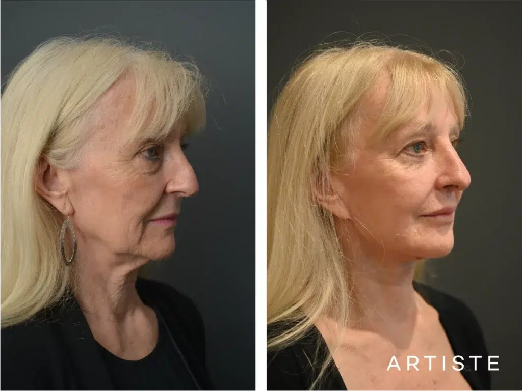 72 Years Old 12 Months Post High Smas Face And Neck Lift Lower Eyelid Surgery Fat Transfer And Lip Lift