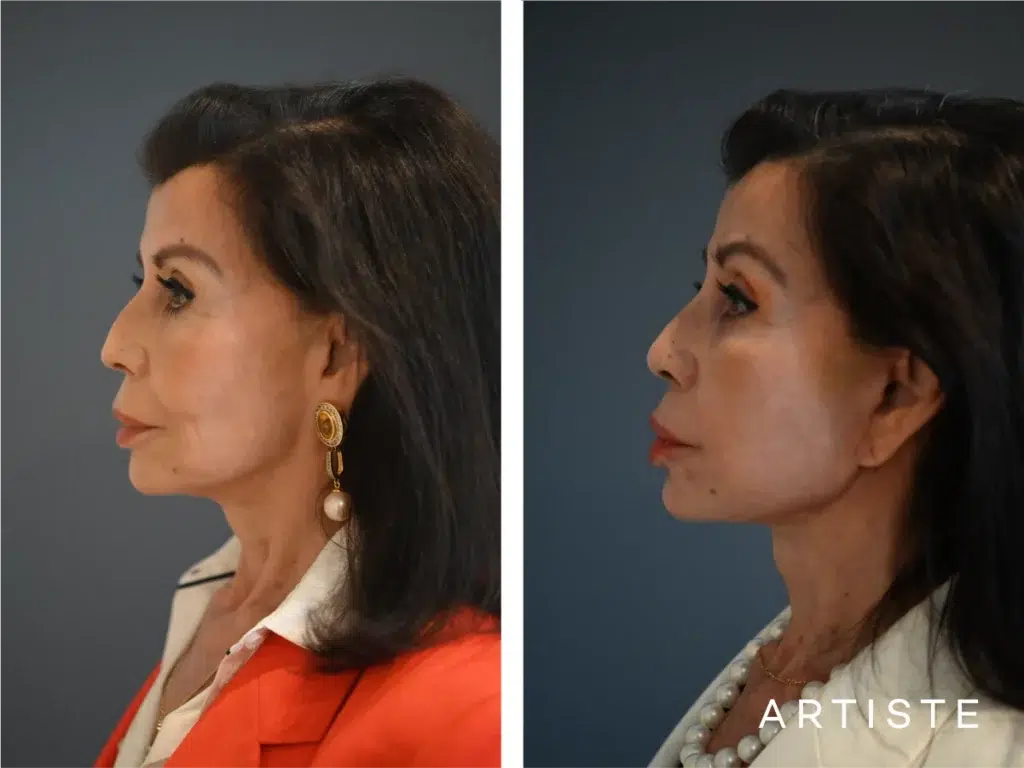 77 Years Old: Female Face And Neck Lift